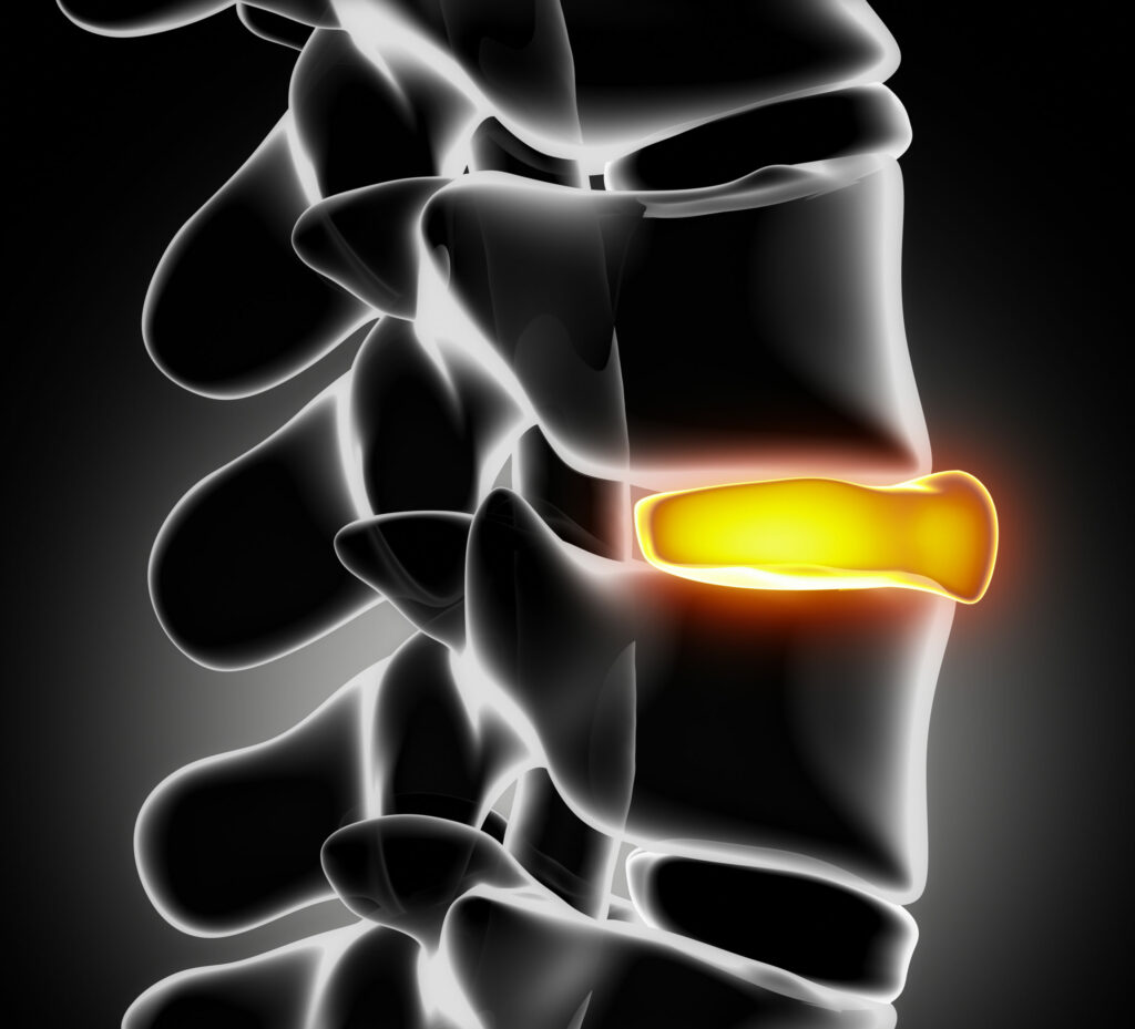 x-ray of ruptured disc in spine